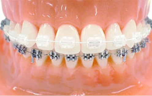 ハーフクリアブラケット