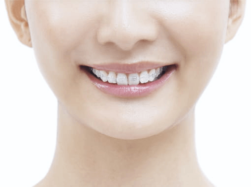 クリアブラケット