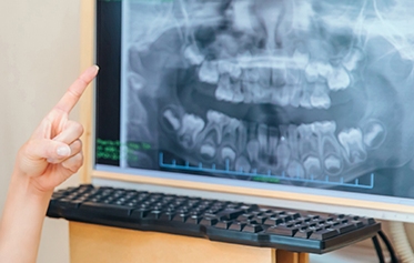 顎の骨の状態に制限がある