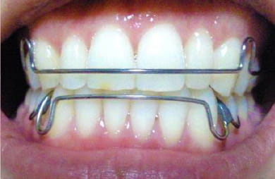 治療終了後の保定