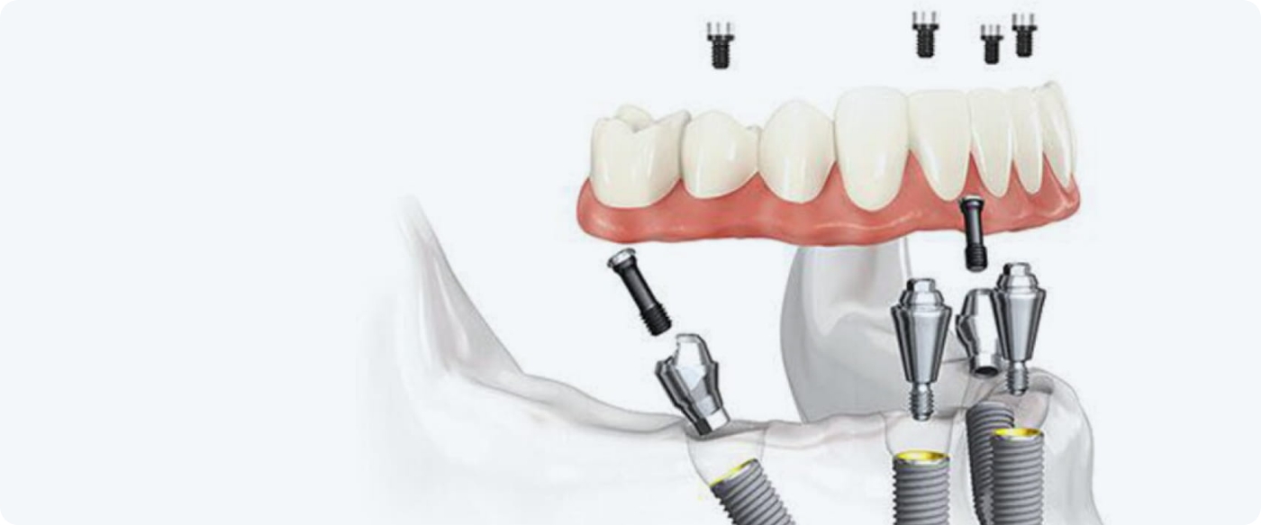 オールオン4とは
