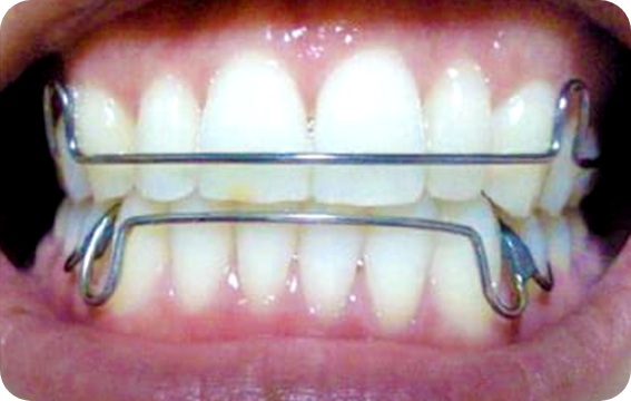 矯正装置の取り外し